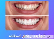 خمیر دندان سفیدکننده smilekit v34